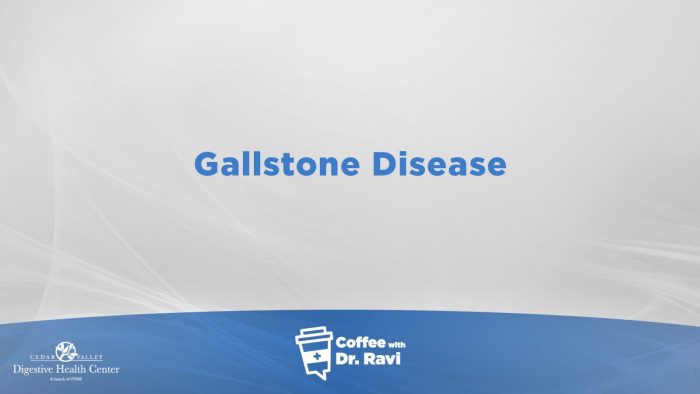 Coffee with Dr. Ravi #74: Gallstone Disease